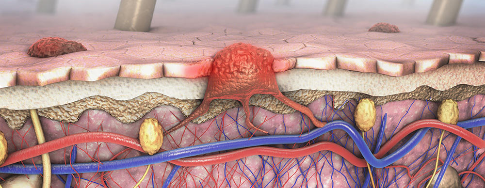 Melanoma Early Warning Signs 1000