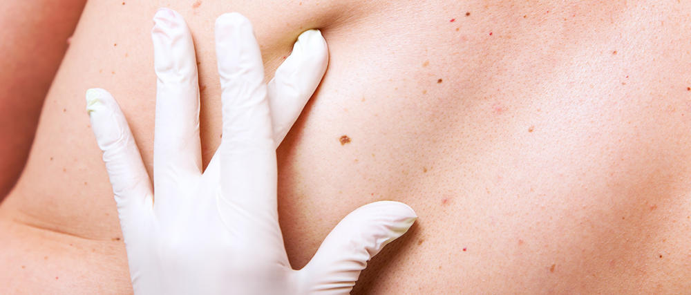 Skin Cancer Checks