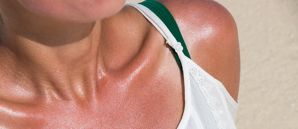 What Is Incidental Sunburn 1000