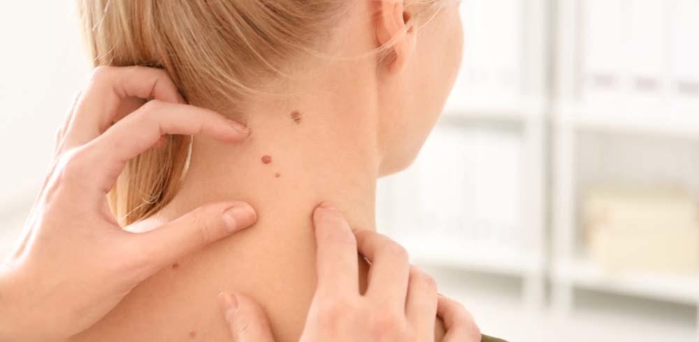 Normal mole or skin cancer
