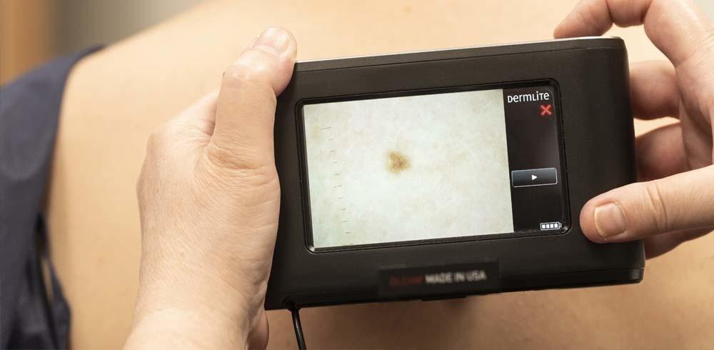 Stages of melanoma development