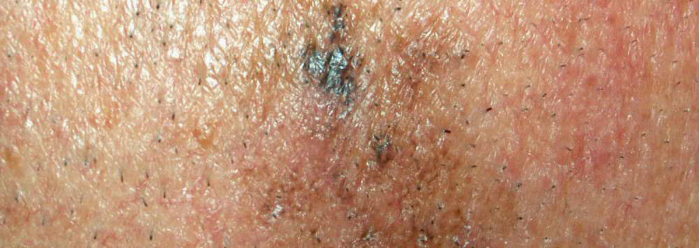 How to identify melanoma early signs of melanoma