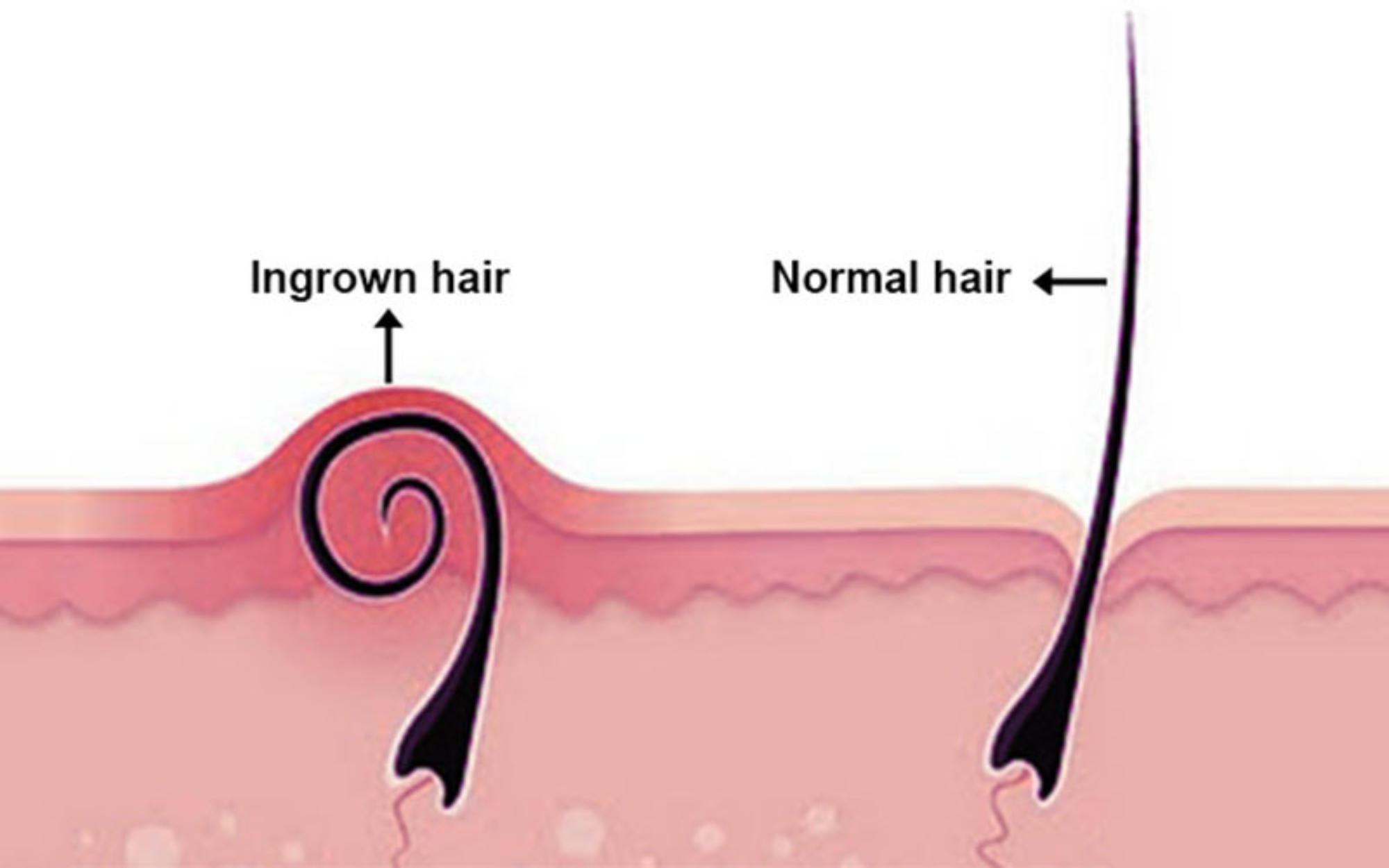 Is It Skin Cancer Or Just An Ingrown Hair Molemap Australia