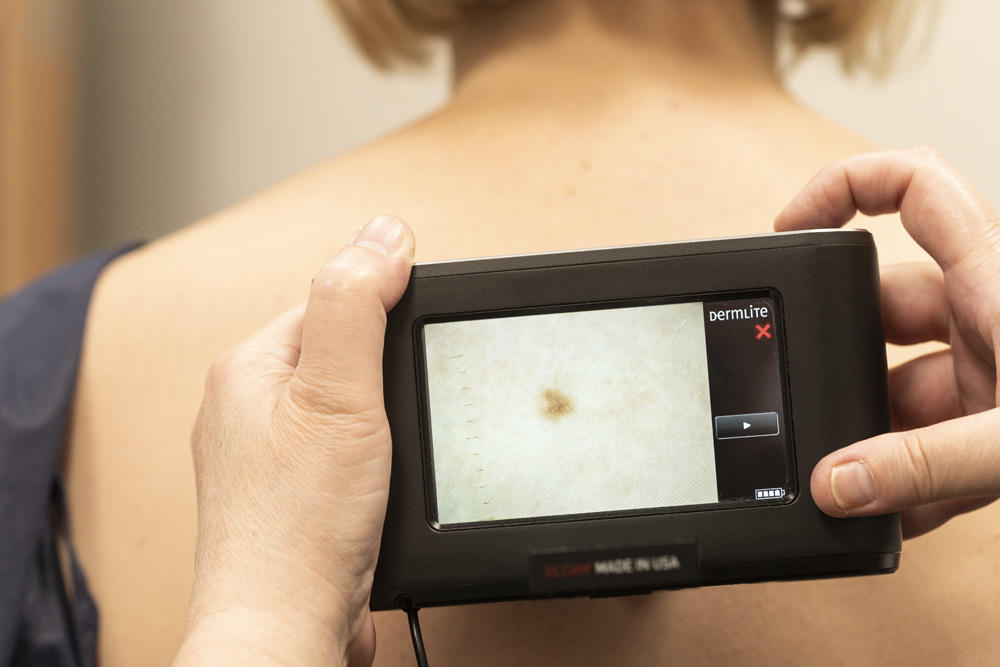 mole skin check near me