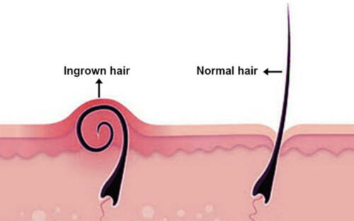 Is It Skin Cancer Or Just An Ingrown Hair Molemap