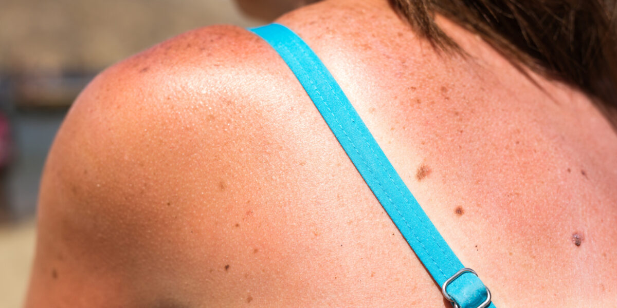 How Many Sunburns Does It Take to Get Skin Cancer? Molemap Australia