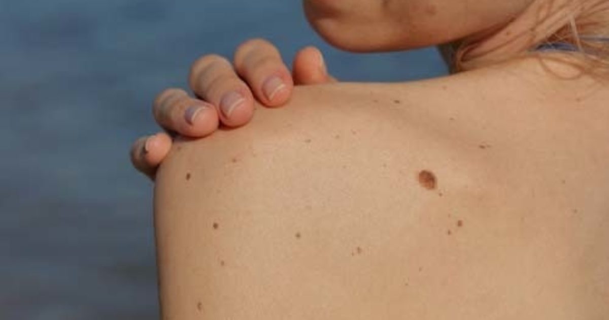 Can you feel skin cancer? All of your important questions answered