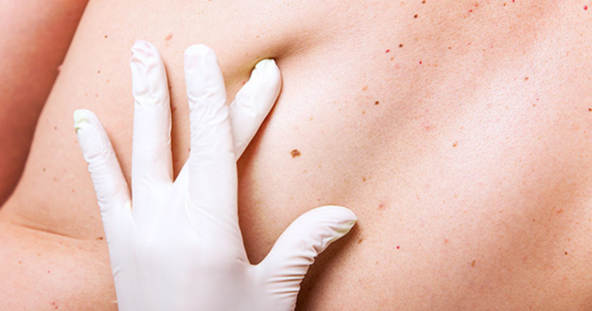 Why you should have a follow-up skin cancer check, every ...