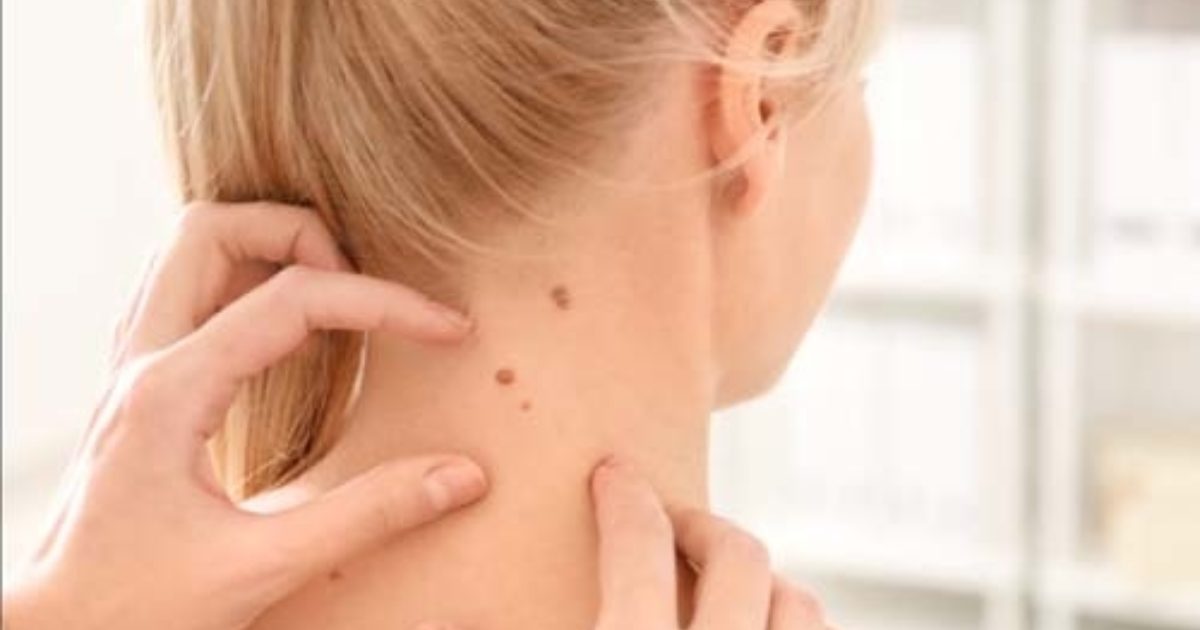 Skin cancer recurrence The essential warning signs you should be aware